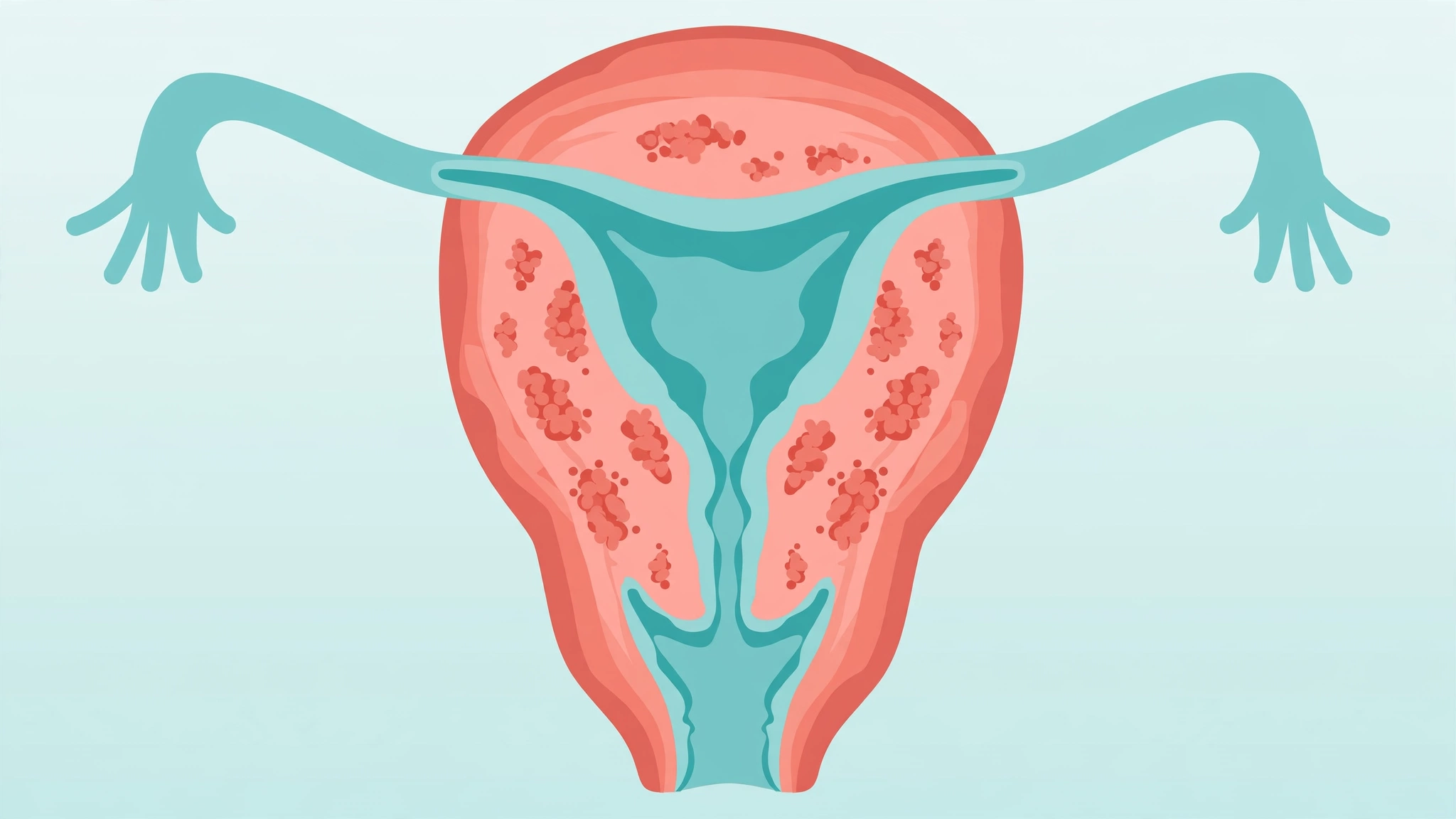 Medical illustration showing adenomyosis painful sex symptoms in the uterus