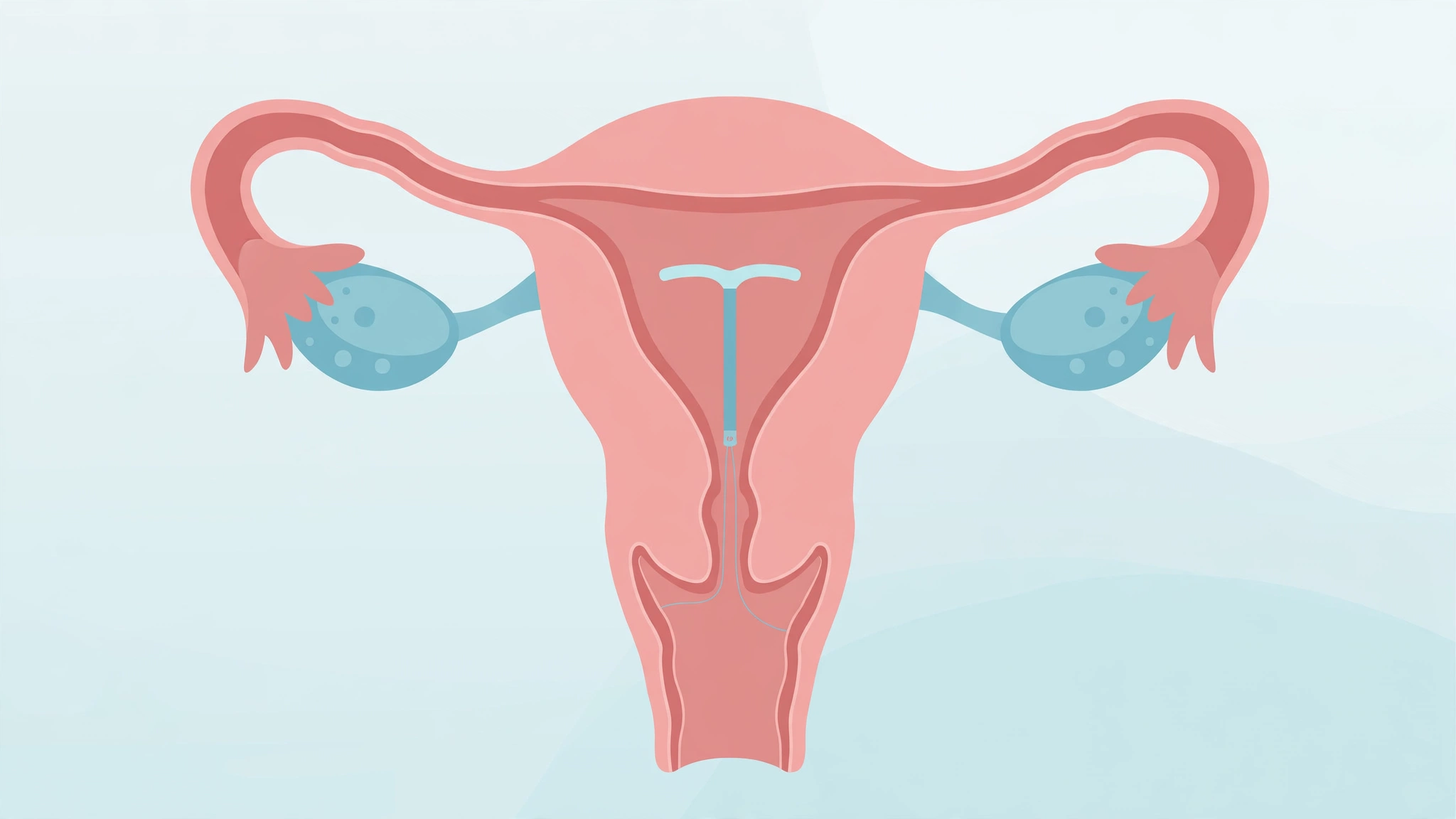Flat medical illustration of an IUD correctly placed inside a uterus cross-section