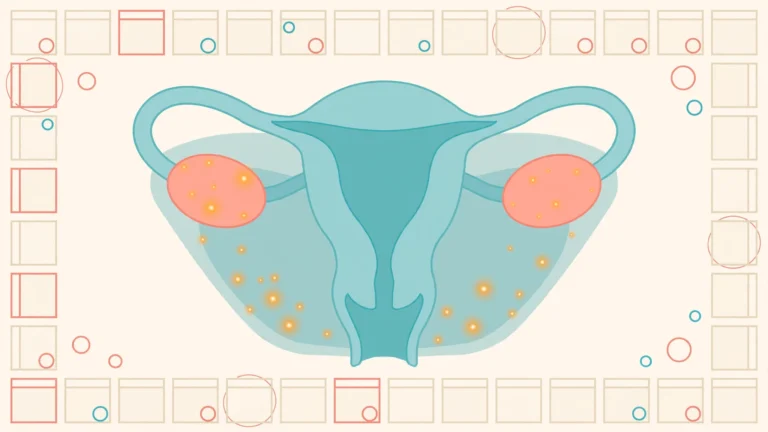 Medical illustration explaining the endometriosis diagnosis delay