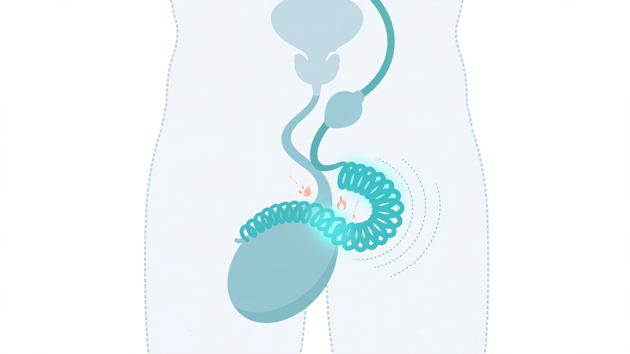 Medical illustration showing epididymitis symptoms and the inflamed epididymis behind the testicle