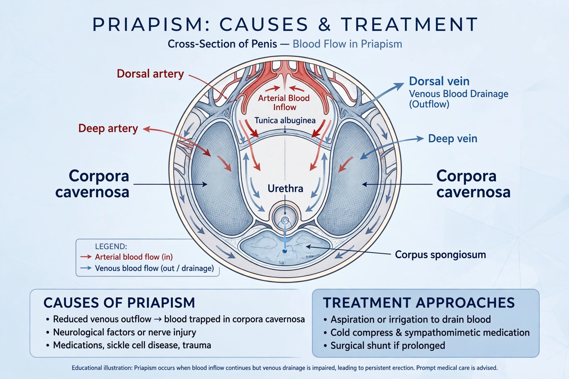 Medical cross-section illustration of penile blood vessels with labeled arteries, veins, corpora cavernosa, and blood-flow arrows explaining priapism causes and treatment